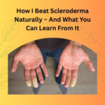 How I Beat Scleroderma Naturally