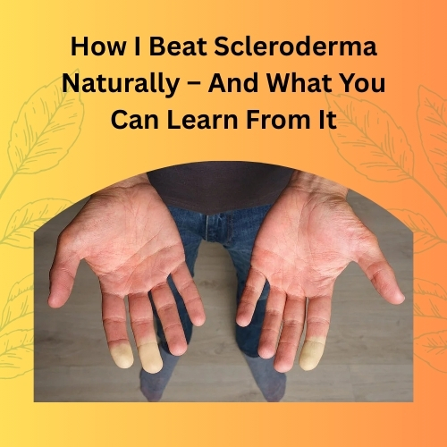How I Beat Scleroderma Naturally