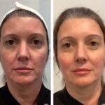 Best Doctors in Dubai Providing Comprehensive Thread Lift Solutions