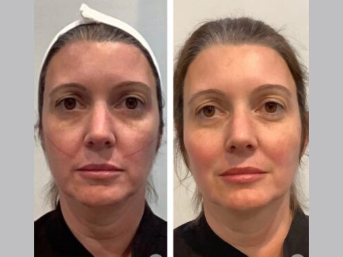 Best Doctors in Dubai Providing Comprehensive Thread Lift Solutions