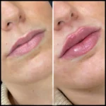 Best Drmal Fillers Doctors in Dubai