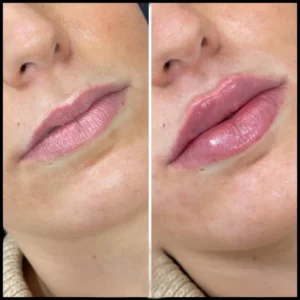 Best Drmal Fillers Doctors in Dubai