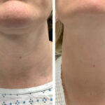 Best Aesthetic Clinic in dubai for Radiofrequency Microneedling Personalized Rejuvenation