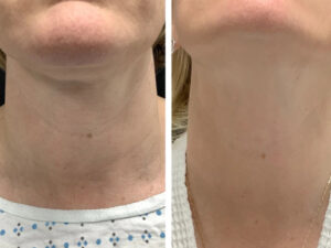 Best Aesthetic Clinic in dubai for Radiofrequency Microneedling Personalized Rejuvenation