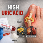 uric-acid
