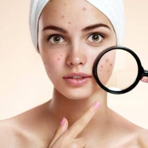 Acne Scar Removal in Dubai