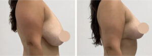 breast lift in dubai