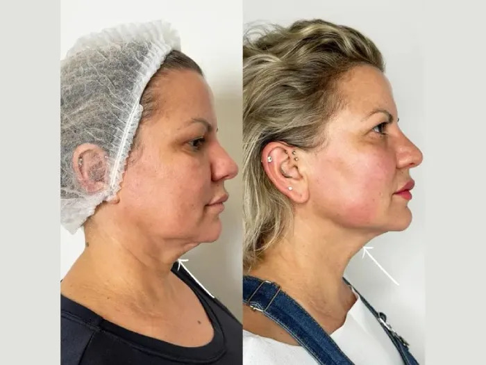 Best Aesthetic Clinics in dubai for Endolift Lower Face Tightening