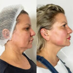 Best Doctors in dubai for Endolift Lower Face Contouring Solutions