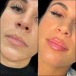 Fillers in Dubai