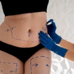 Liposuction