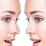 rhinoplasty in dubai