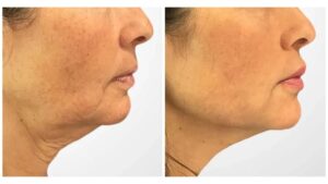 Best Aesthetic Clinics in Dubai Offering Innovative Non-Surgical Thread Lift