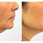 Thread Lift Treatment in Dubai Offering Subtle Facial Enhancement With Precision Methods
